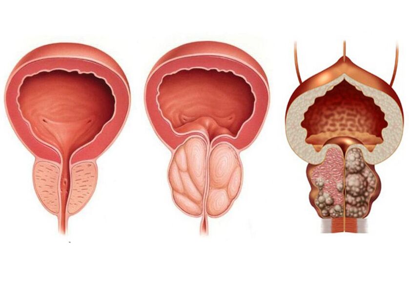 Fase di prostatite e la necessità di usare pienamente la prostavit