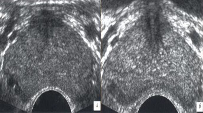 Ultrasuoni prima e dopo il trattamento con gocce di valore ZxcvbnmQ