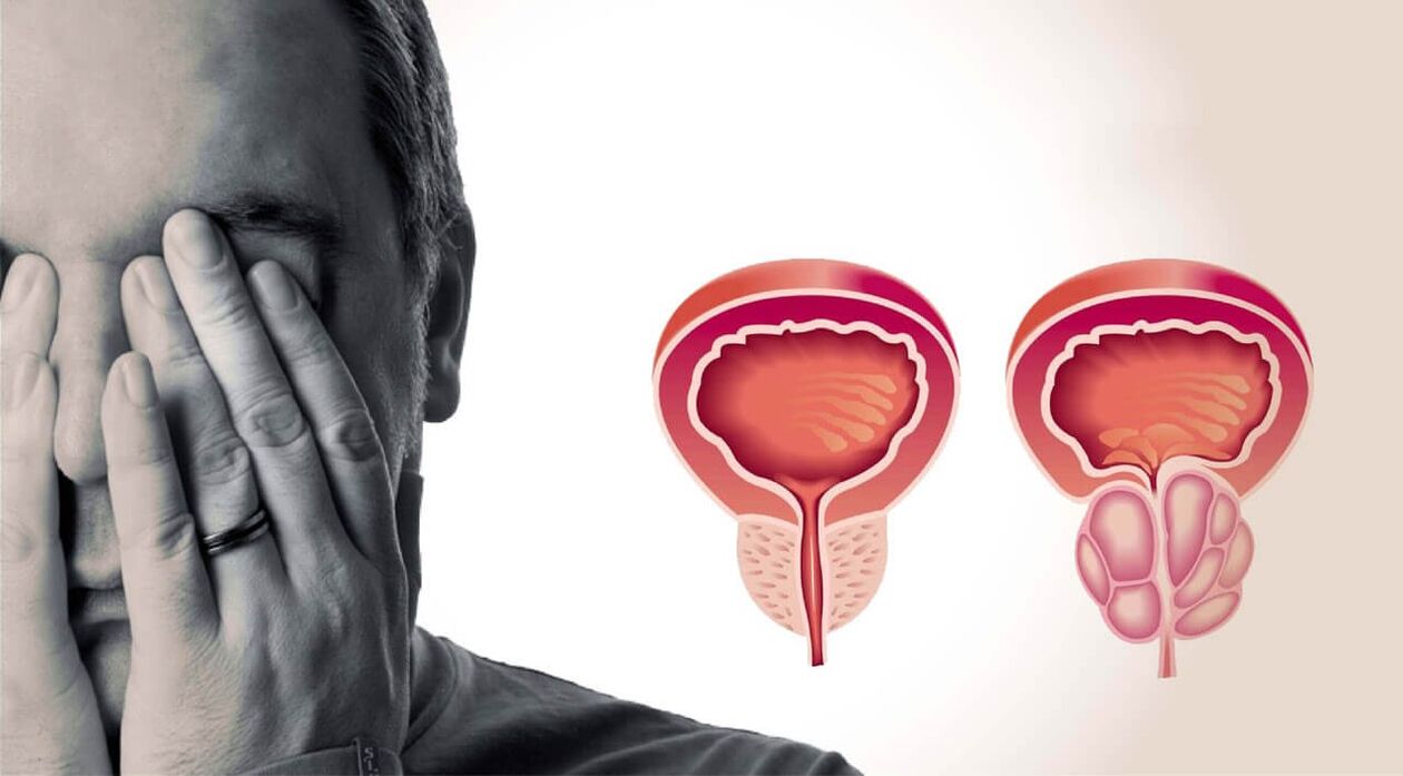 Prostata sana e dolorante negli uomini